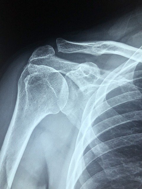 Healthy Shoulder | Wisconsin Personal Injury Doctor