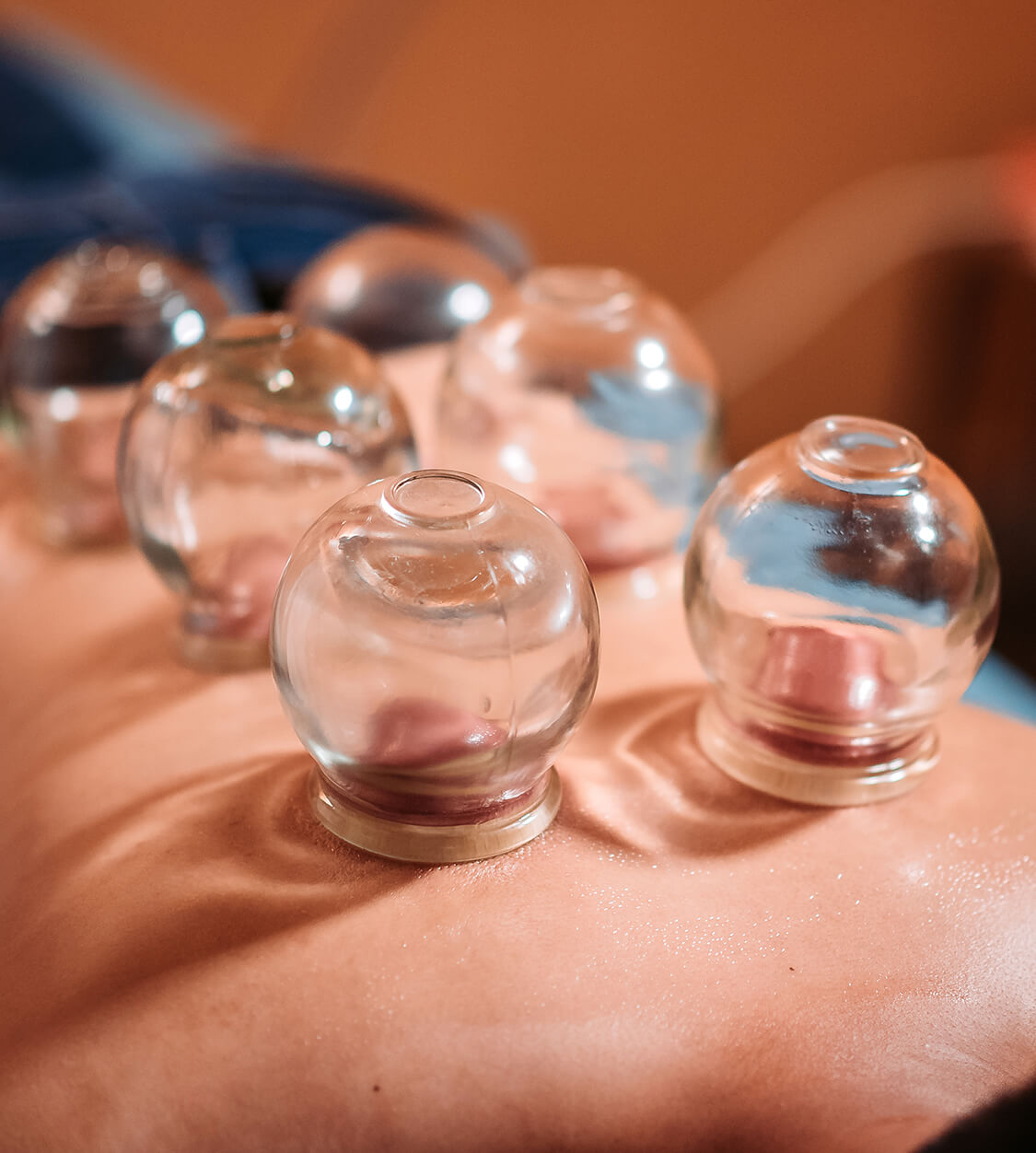Cupping physical therapy treatment for personal injury patients